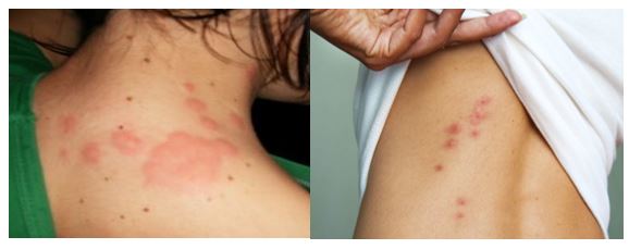 علایم گزش ساس تختخواب در نواحی مختلف بدن